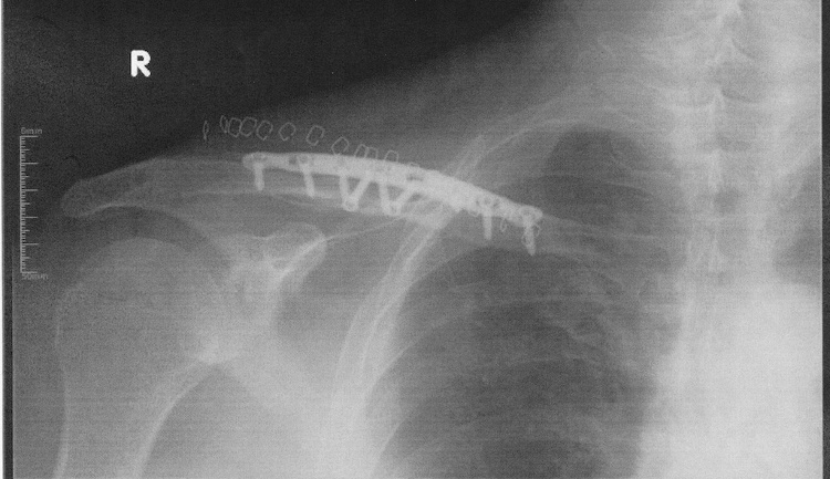 my_repaired_right_clavicle.jpg